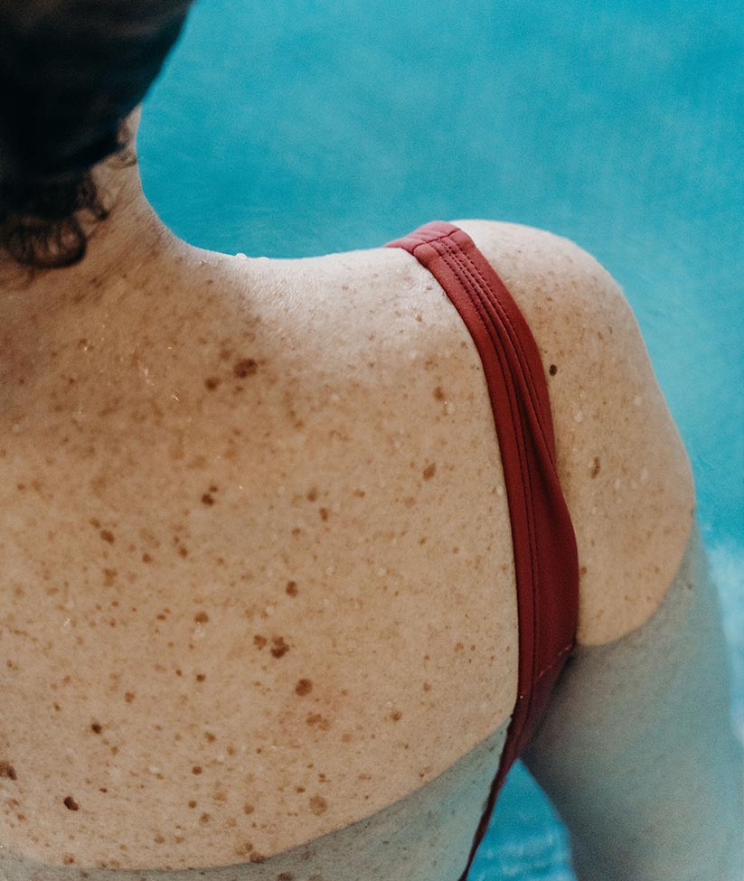 Checking a changing mole during a skin examination at The Watermill Clinic, Wickham